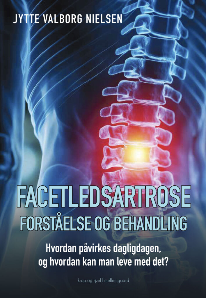 Billede af borgens forside - facetledsartrose